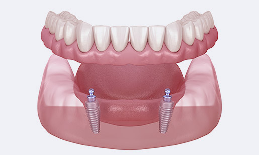 Supported Denture