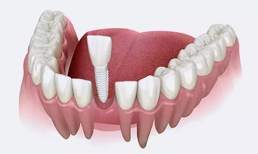 Diagram of single dental implant