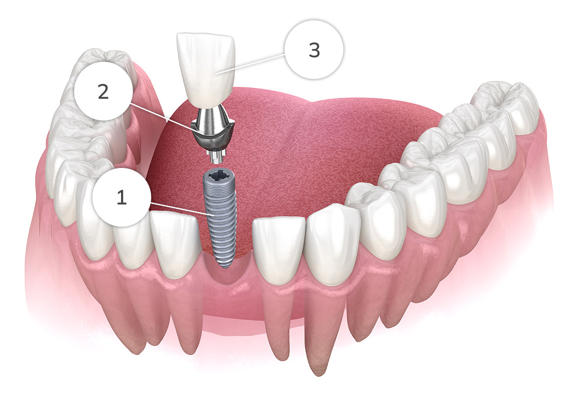 Dental implants Fall River 
